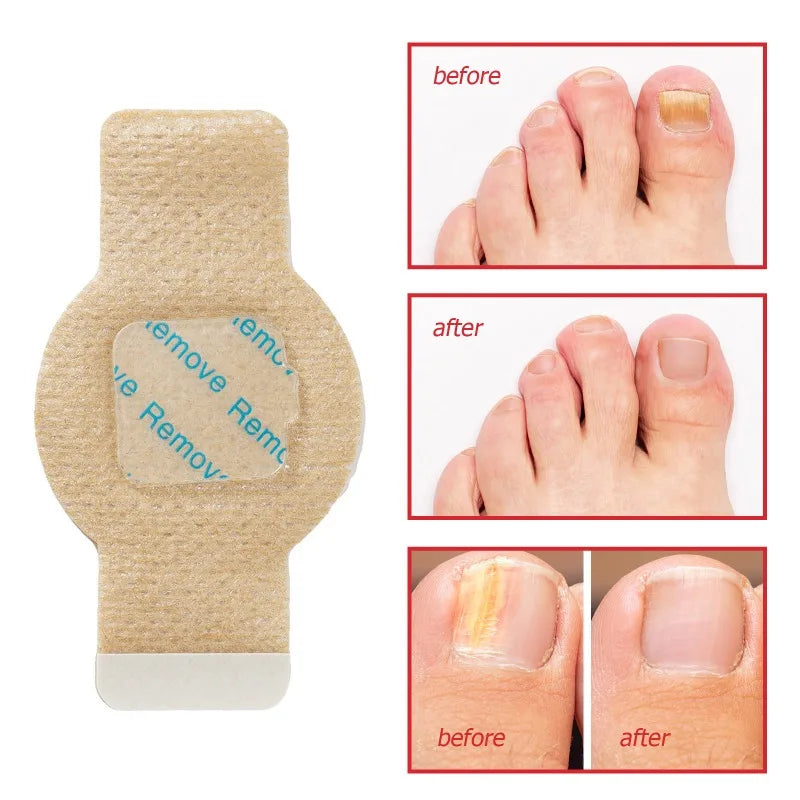 Nagelvital™ Effektive Hilfe gegen Nagelpilz